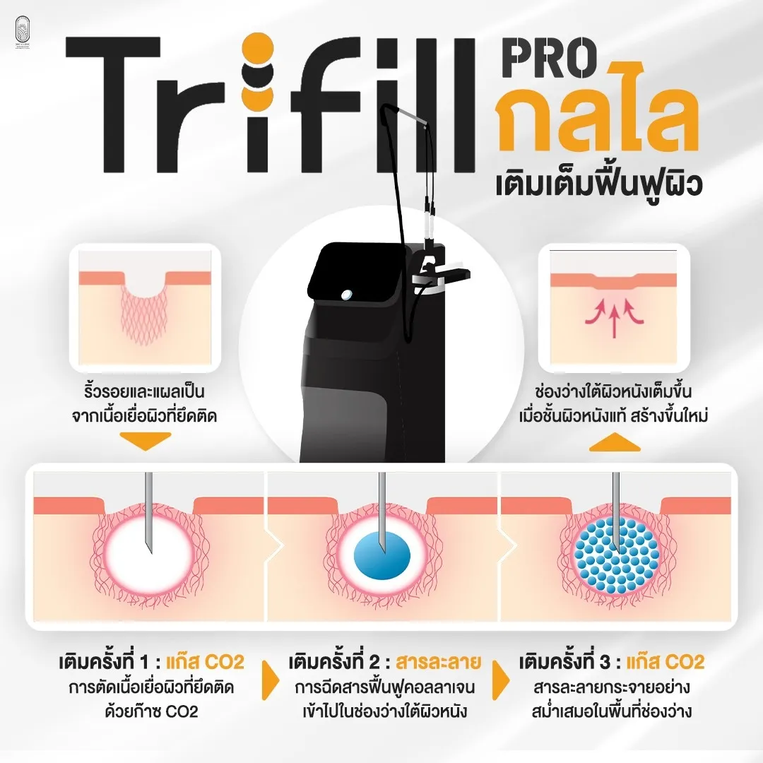 Trifill Pro Air Subcision ตัดพังผืดหลุมสิว กลไกเติมเต็มฟื้นฟูผิว