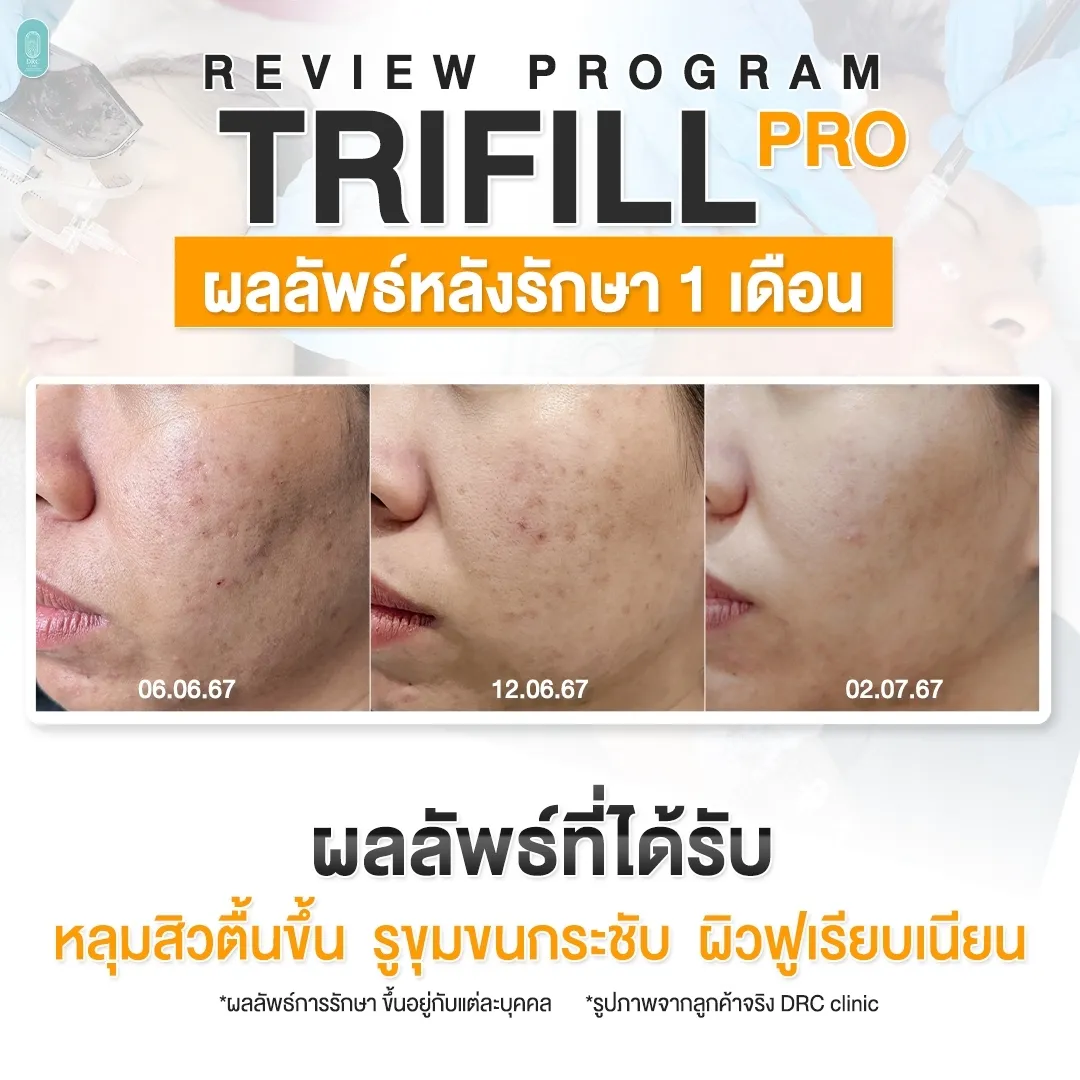 Trifill Pro Air Subcision ตัดพังผืดหลุมสิว ผลการทำ 1 เดือน