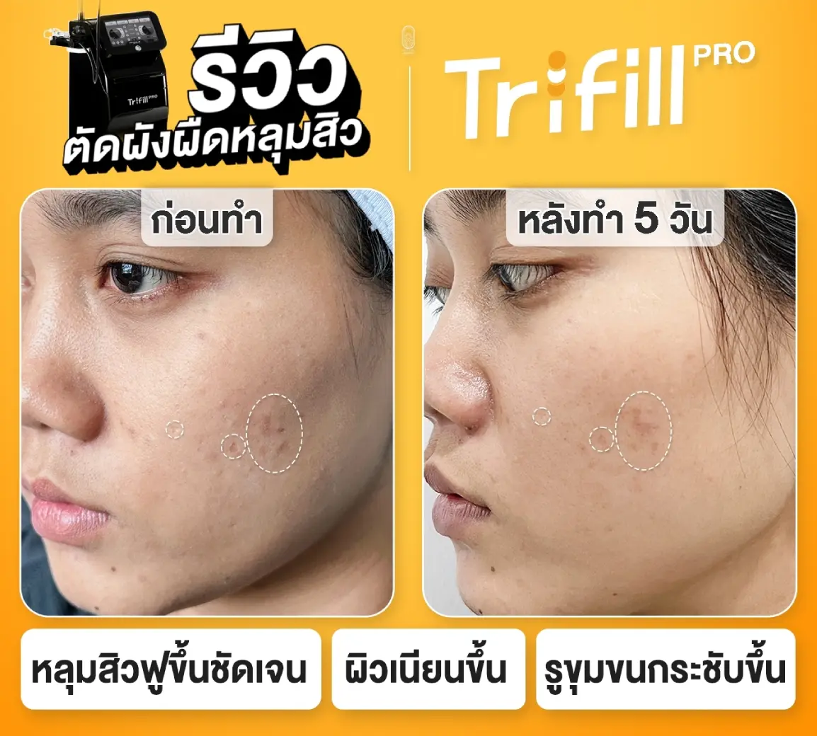 Trifill Pro Air Subcision ตัดพังผืดหลุมสิว เปรียบเทียบก่อนและหลังทำ 5 วัน หลุมสิวฟูขึ้นชัดเจน