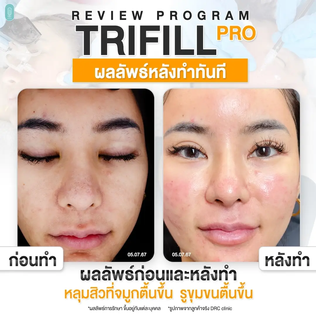 Trifill Pro Air Subcision ตัดพังผืดหลุมสิวที่ เทียบก่อนทำหลังทำ 001