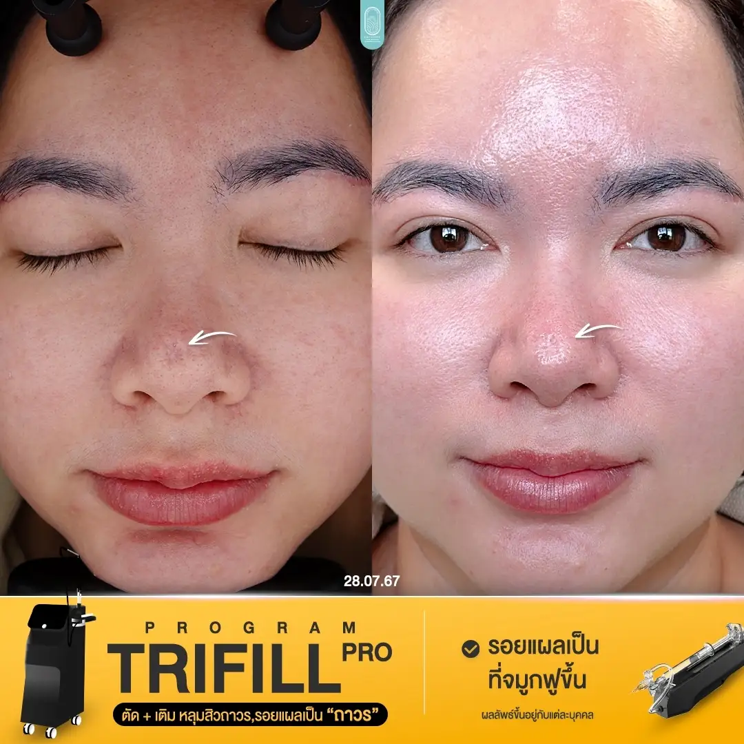 Trifill Pro Air Subcision ตัดพังผืดหลุมสิวที่ เทียบก่อนทำหลังทำทันที 001