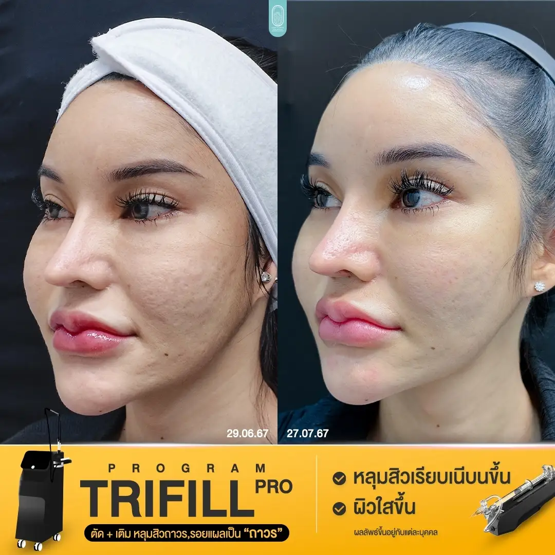 Trifill Pro Air Subcision ตัดพังผืดหลุมสิวที่ เทียบก่อนทำหลังทำทันที 004